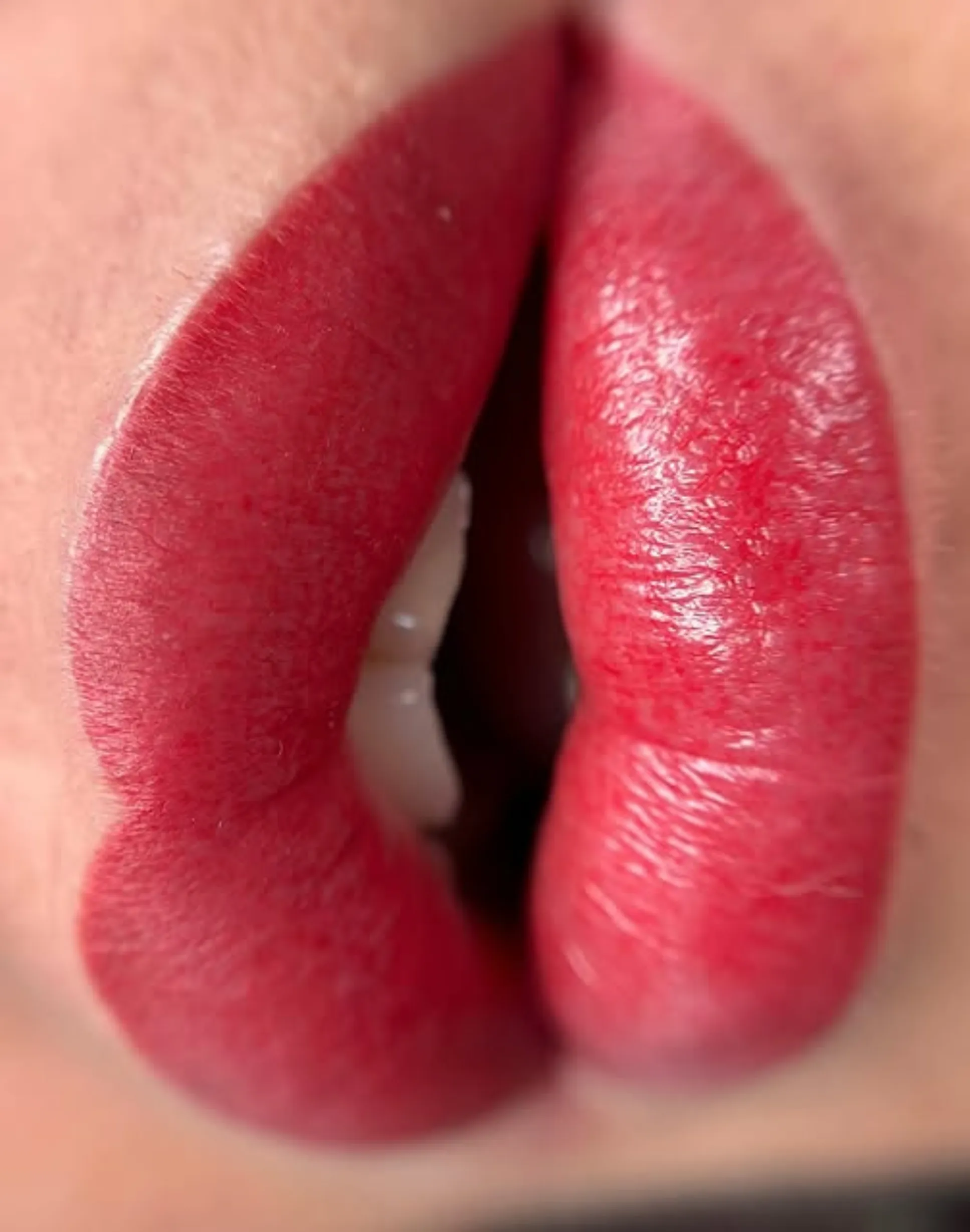What is the pink lip procedure?